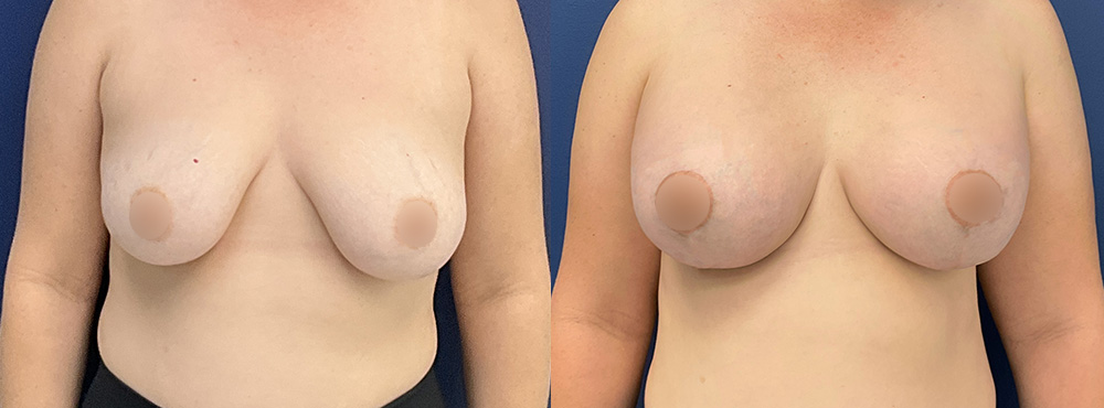 Breast Lift  Before and After