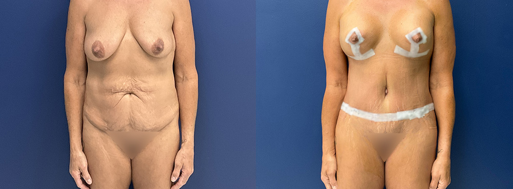 Tummy Tuck Before and After
