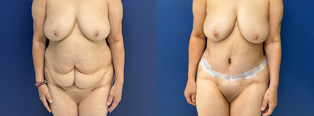 Tummy Tuck Before and After