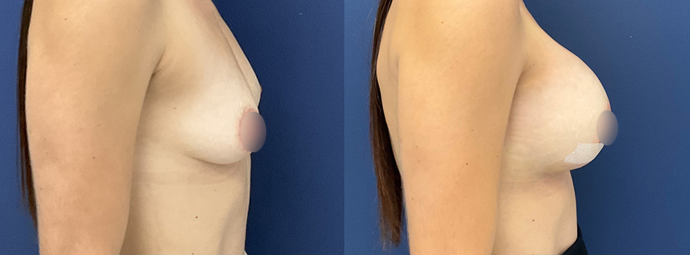 Breast Augmentation Before and After