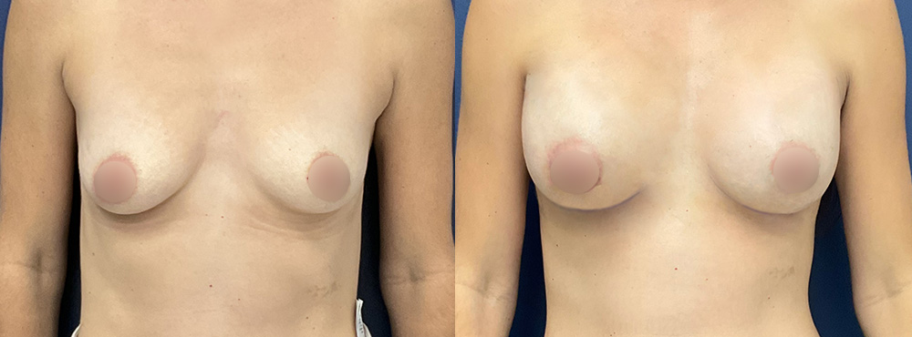 Breast Augmentation Before and After