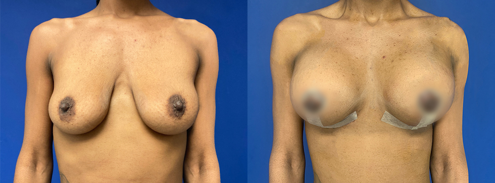 Breast Augmentation Before and After