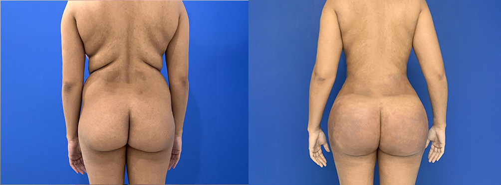 BBL Before and After