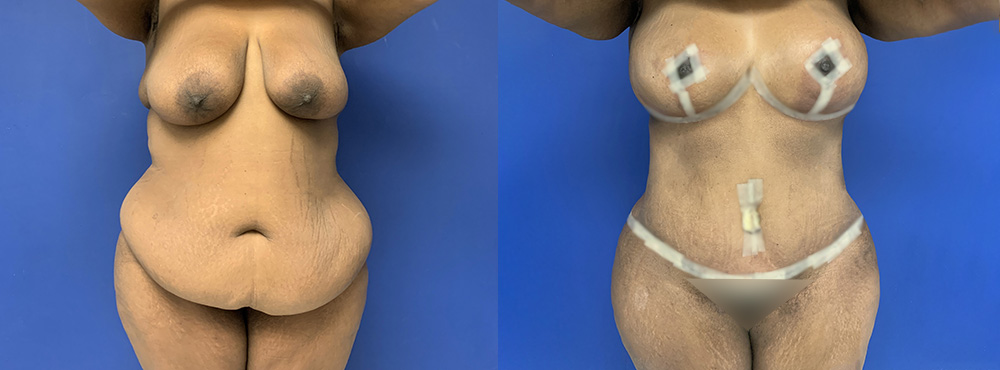 Mommy Makeover Before and After