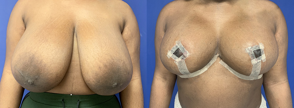 Breast Lift Before and After