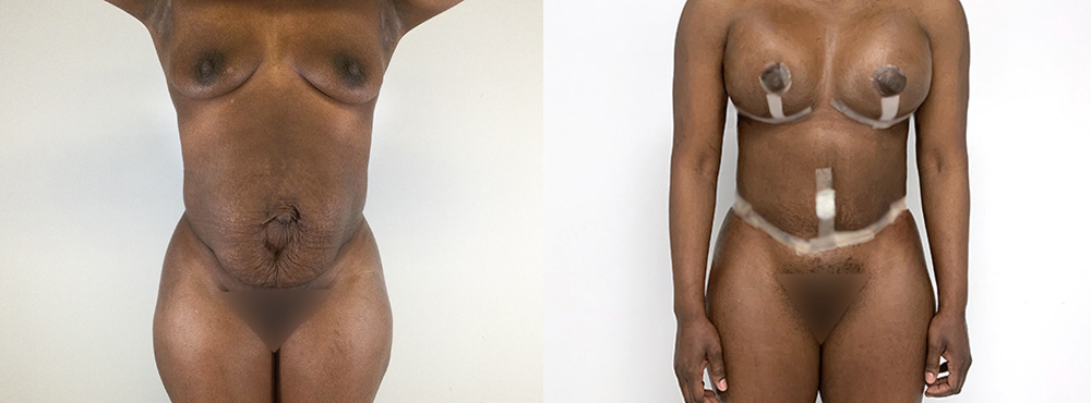 Mommy Makeover Before and After