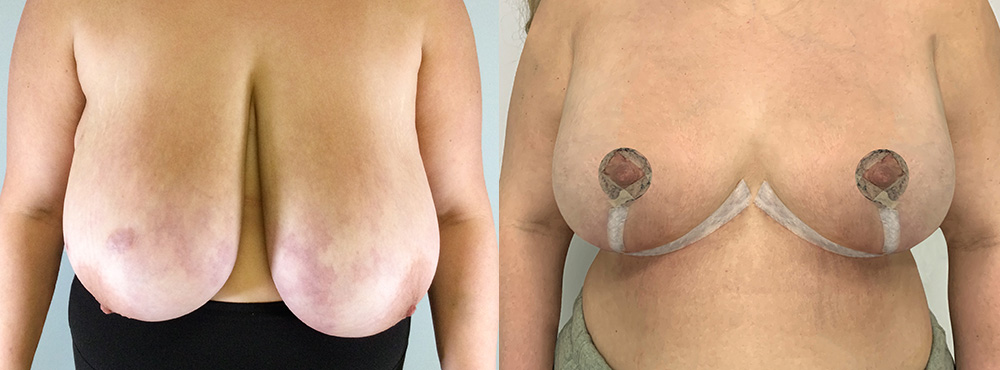 Breast Reduction Before and After