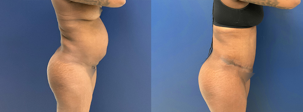 Tummy Tuck Before and After