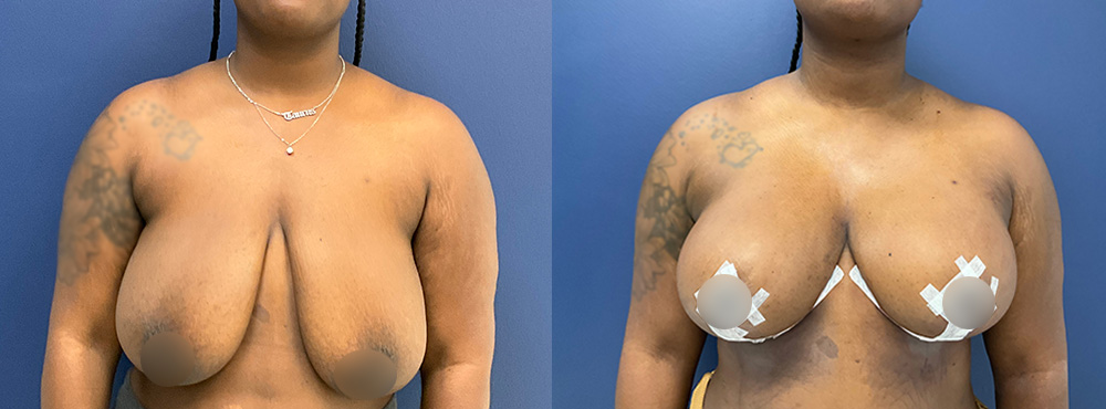 Breast Reduction Before and After