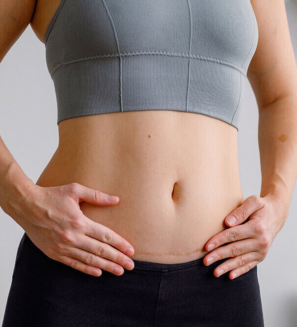 About Tummy Tuck Scars