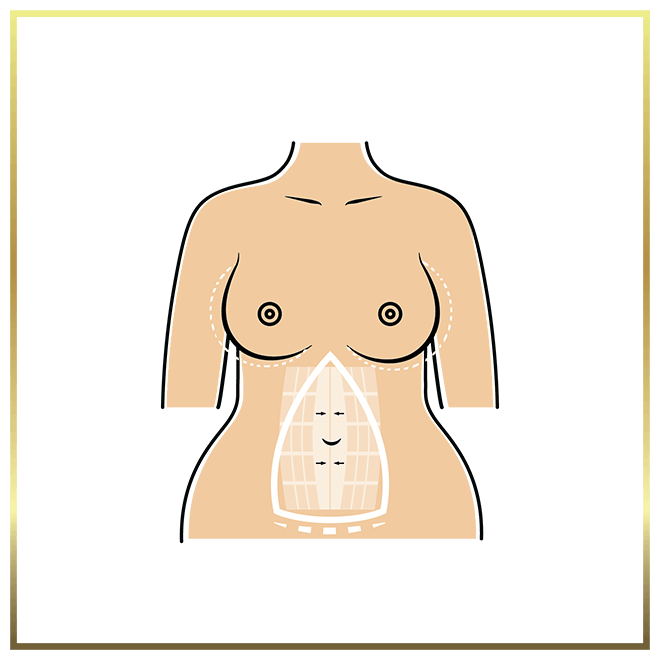 Transabdominoplasty breast augmentation