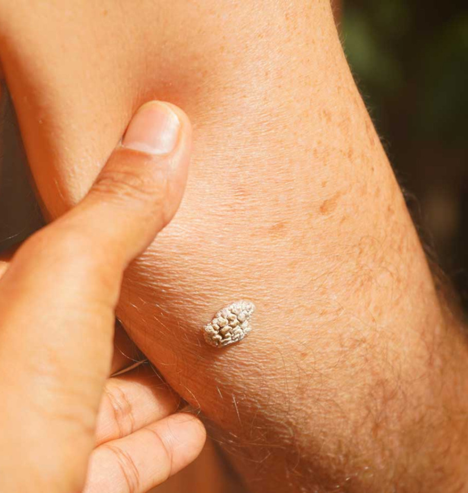 Keratosis Removal in Miami