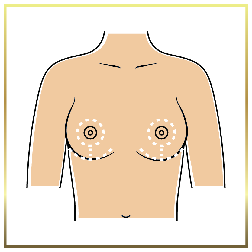 anchor breast lift