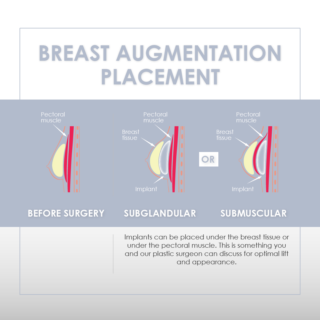 Breast implants placement infographic