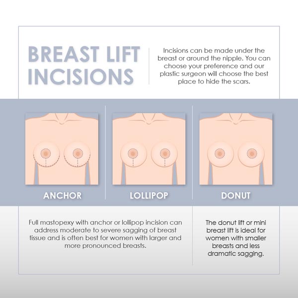 Breast lift incisions infographic