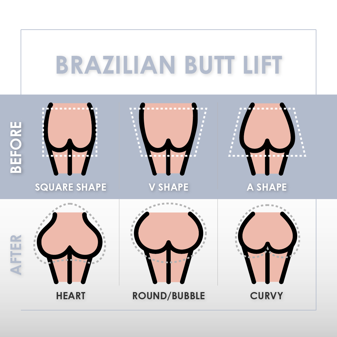 Butt shapes before and after Brazilian Butt Lift