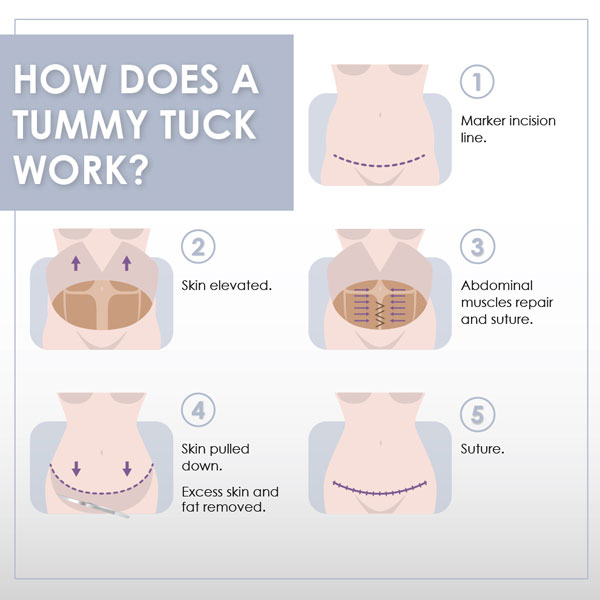 How does a tummy tuck work