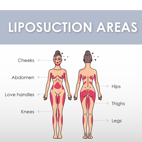 Liposuction areas