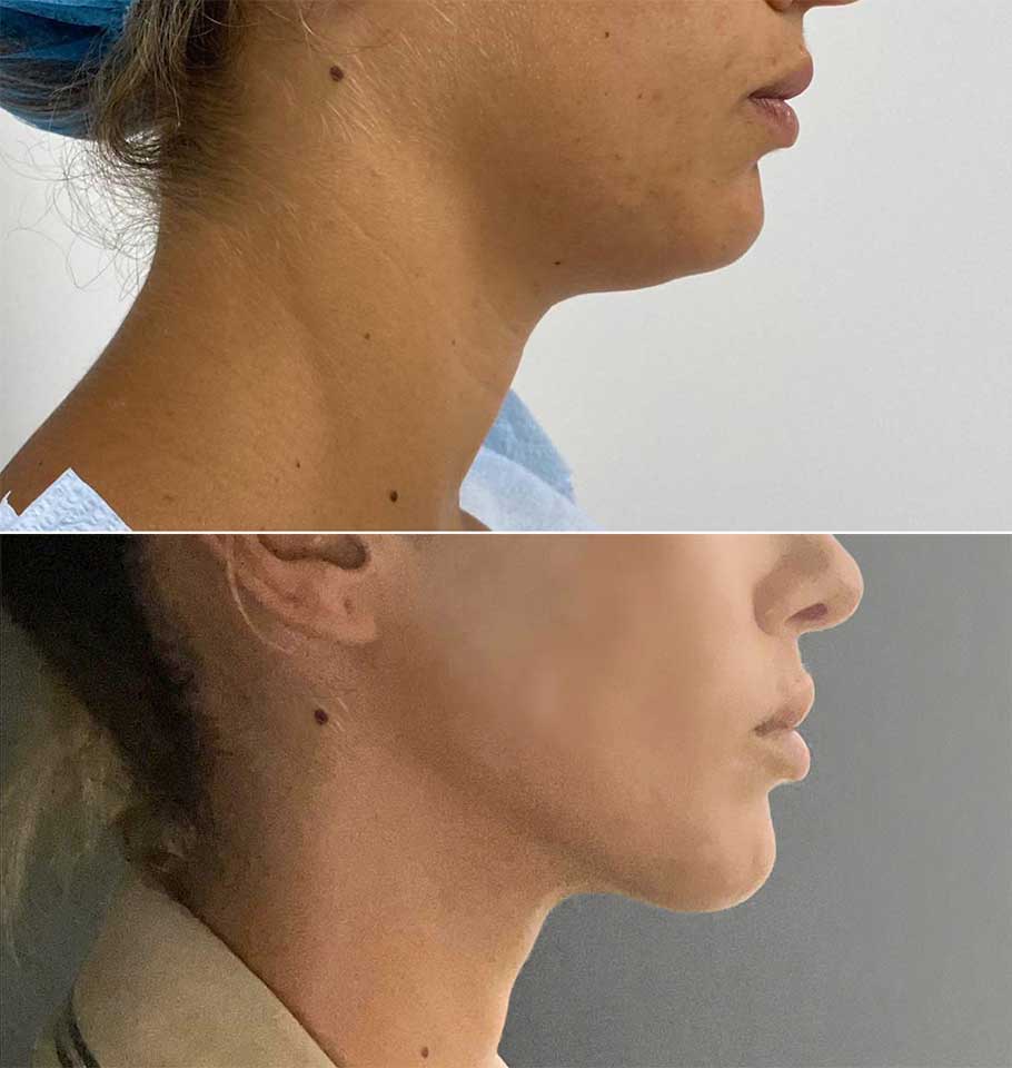 neck chin liposuction miami