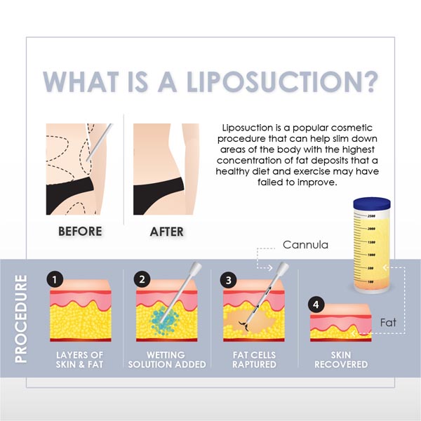 What is a liposuction infographic