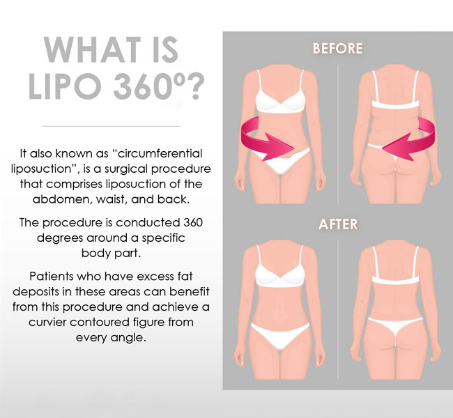 St Louis Flank and Hip Liposuction Procedure