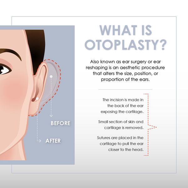 What is otoplasty