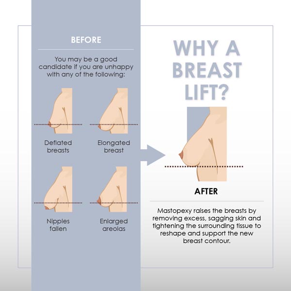 Why a breast lift