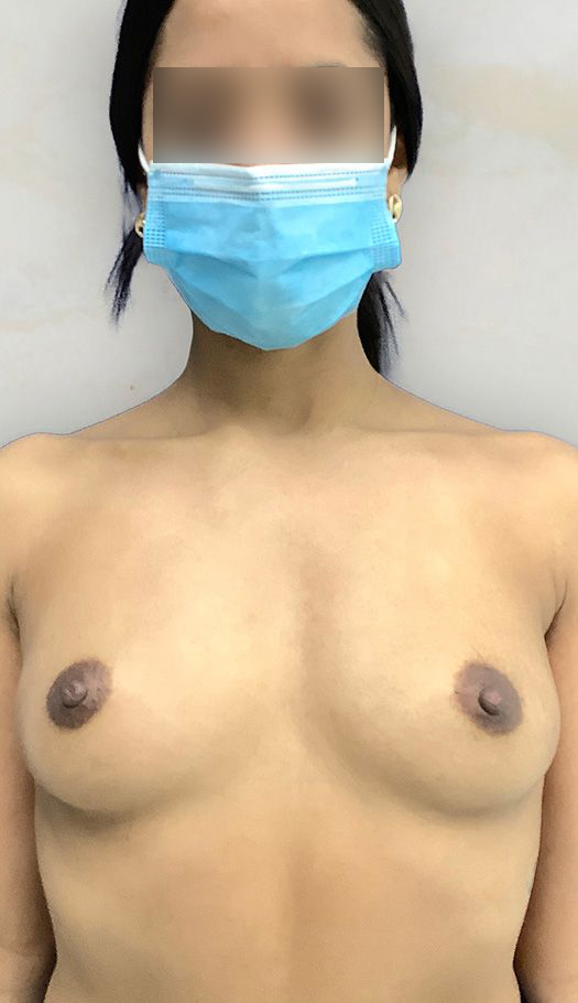 breast augmentation by dr golio 26426 before