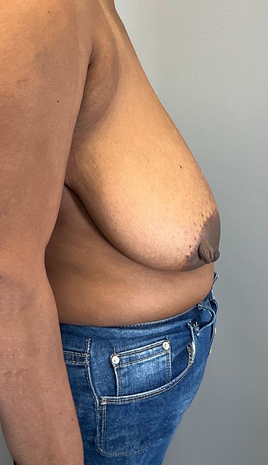 breast lift by mameniski 113810 before