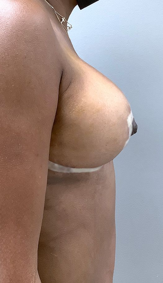breast lift by mameniski 66672 after