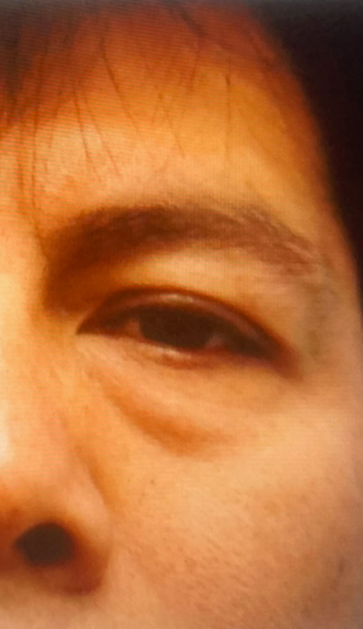 eyelid surgery 1 before