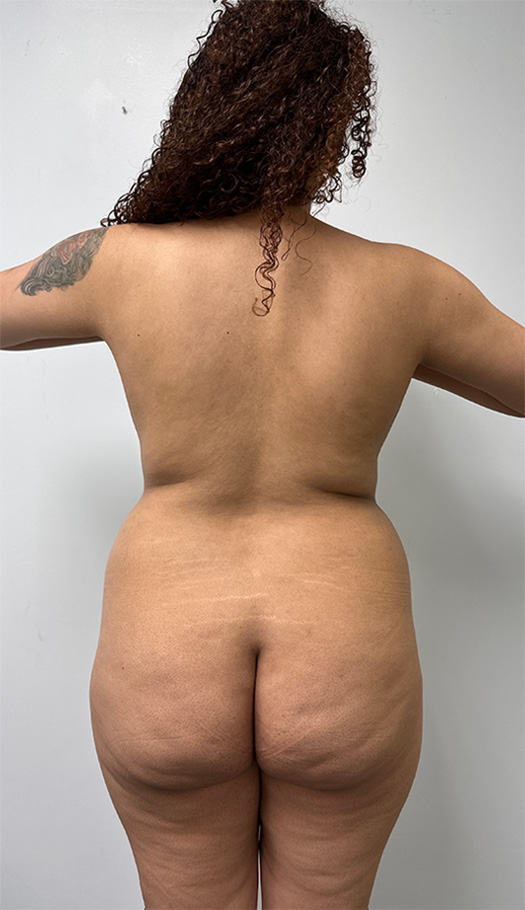 lipo 360 dr hasan 143895 2 before