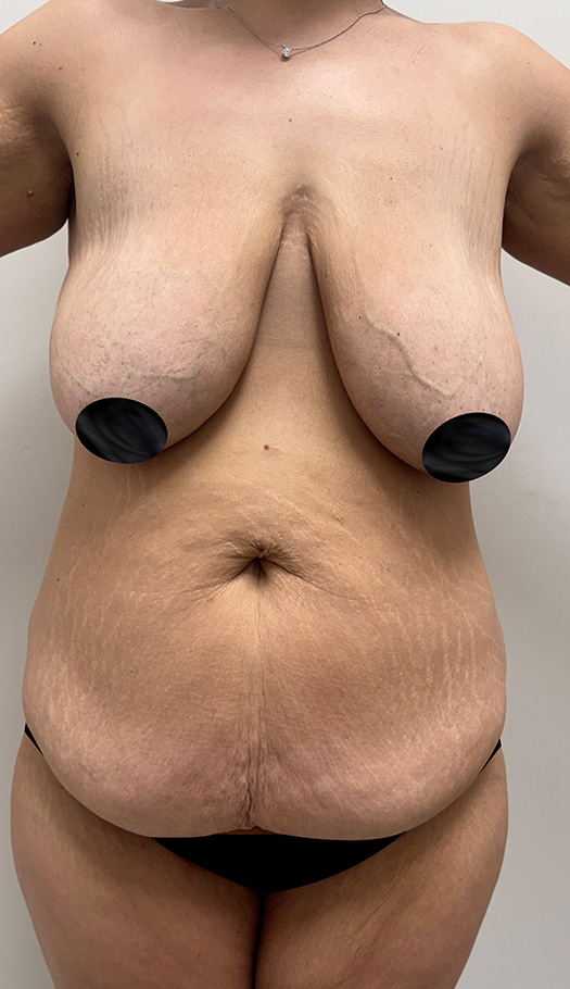 mommy makeover by dr luster 264282 before