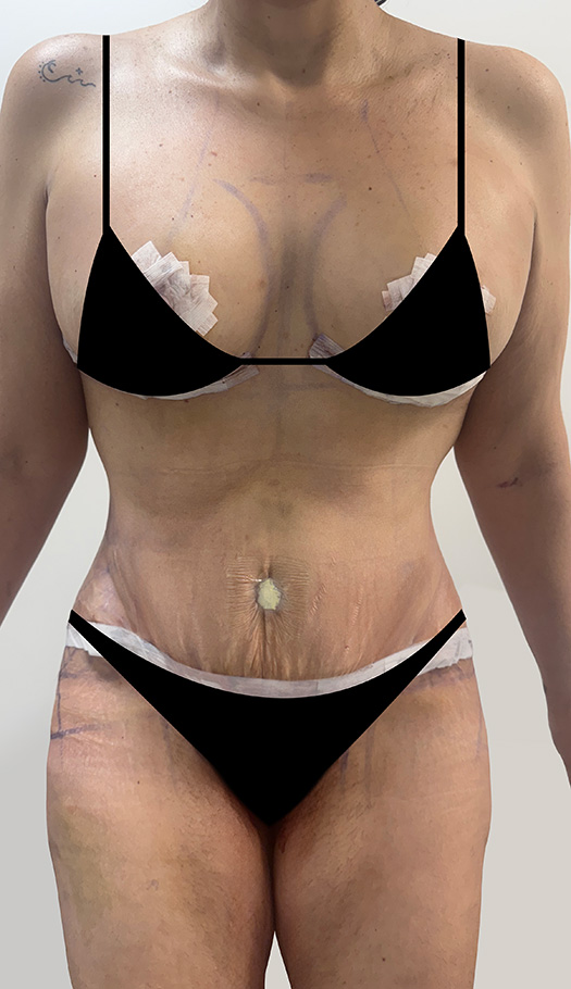 mommy makeover by dr luster 290196 after