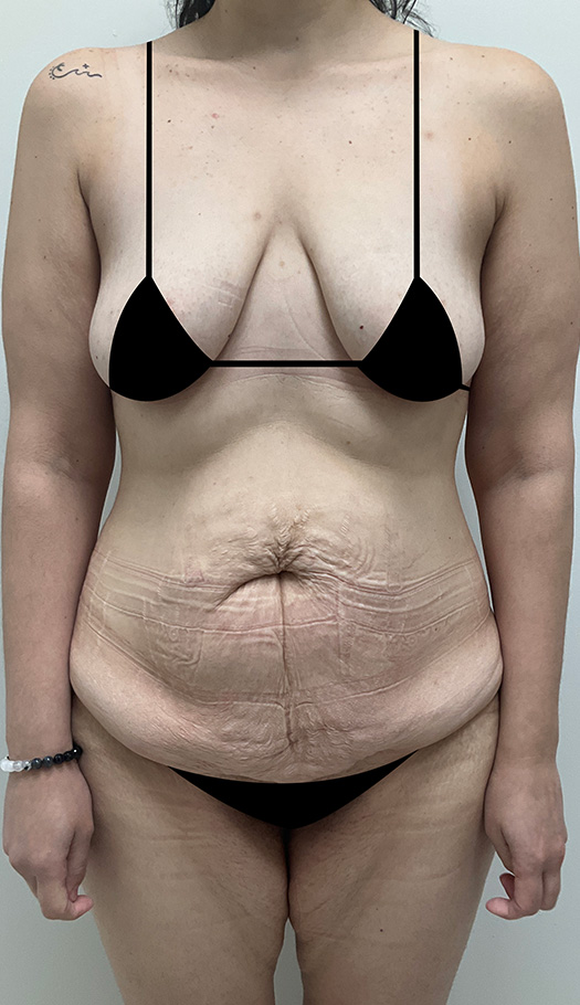 mommy makeover by dr luster 290196 before