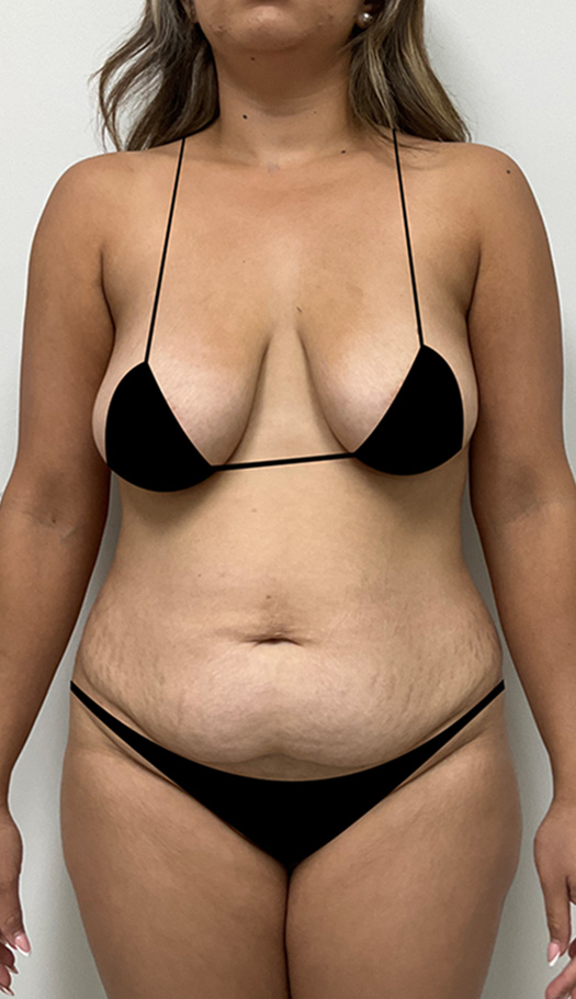 mommy makeover by dr pane 298570 before