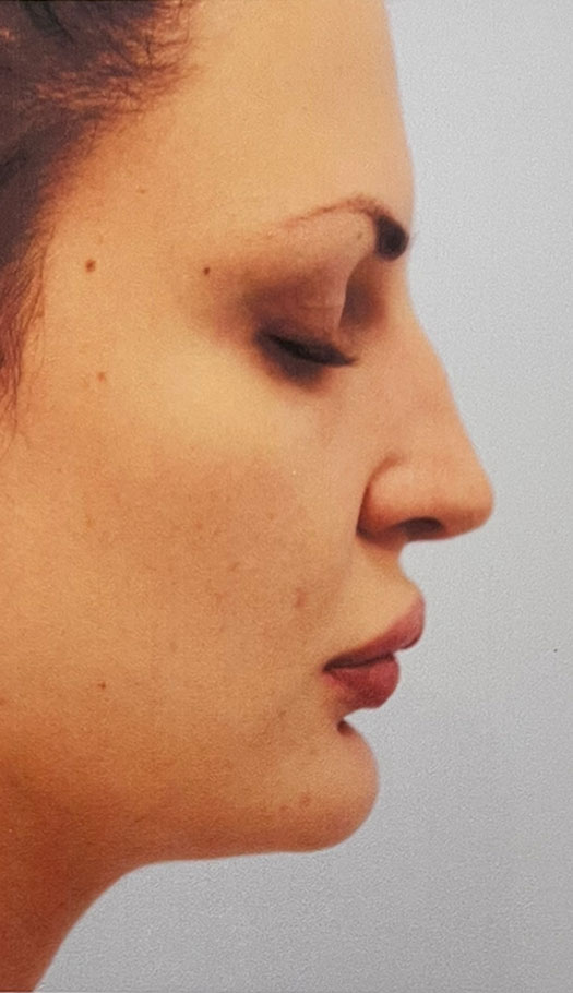 rhinoplasty 1 before