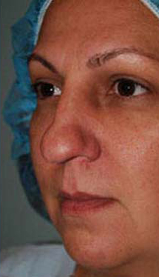 rhinoplasty 4 before