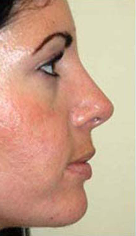 rhinoplasty 5 after