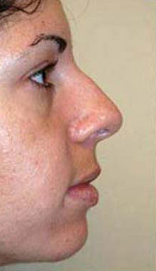 rhinoplasty 5 before