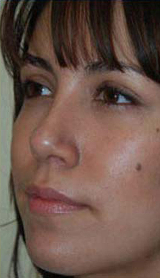 rhinoplasty 6 after