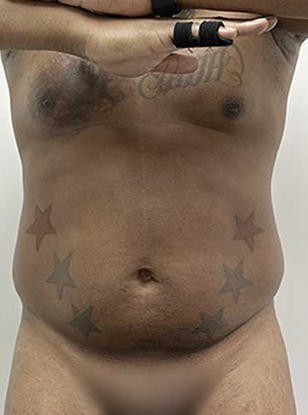 Antes