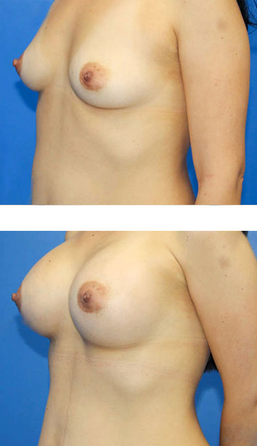 transumbilical breast augmentation before and after case 3
