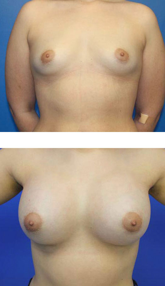 transumbilical breast augmentation before and after case 4