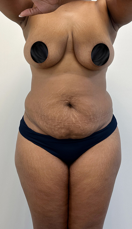 tummy tuck by dr mameniskis 169459 before