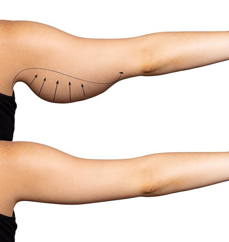 Proceso de una Braquioplastia enAvana Plastic Surgery