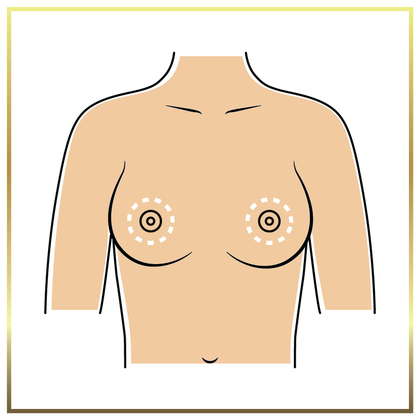 donut breast lift