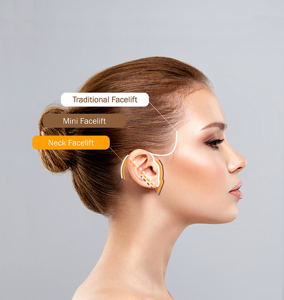 facelift corrects