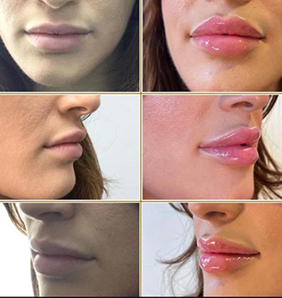 aumento de labios en Miami antes y depues
