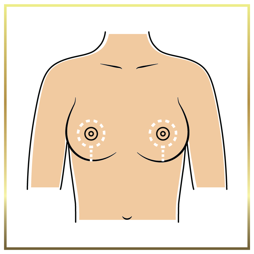 lollipop breast lift